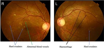Case report: Diabetic muscle infarction with diabetic ketoacidosis: A rare complication of diabetes